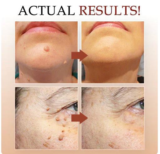 Tags & Moles Remover Buy 1 Get 1 FREE